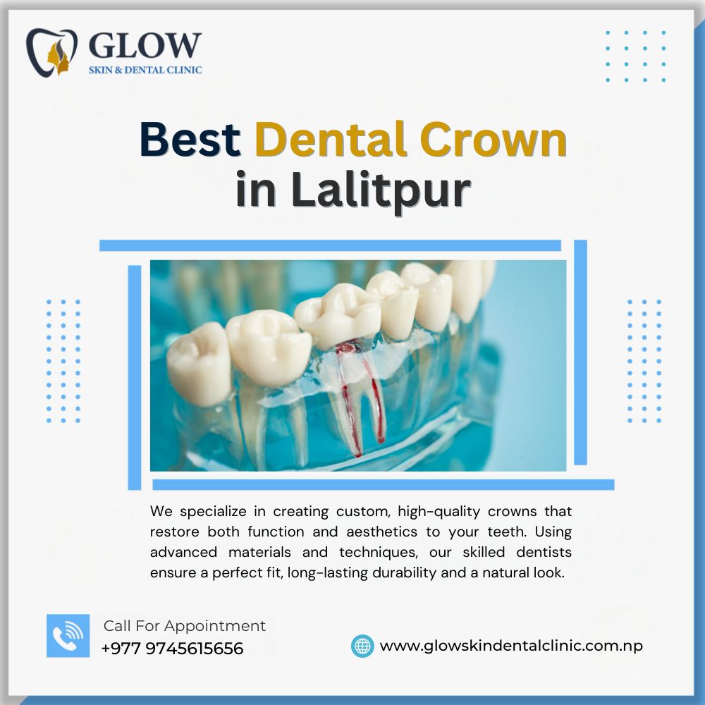 Best Dental Crown in Lalitpur
