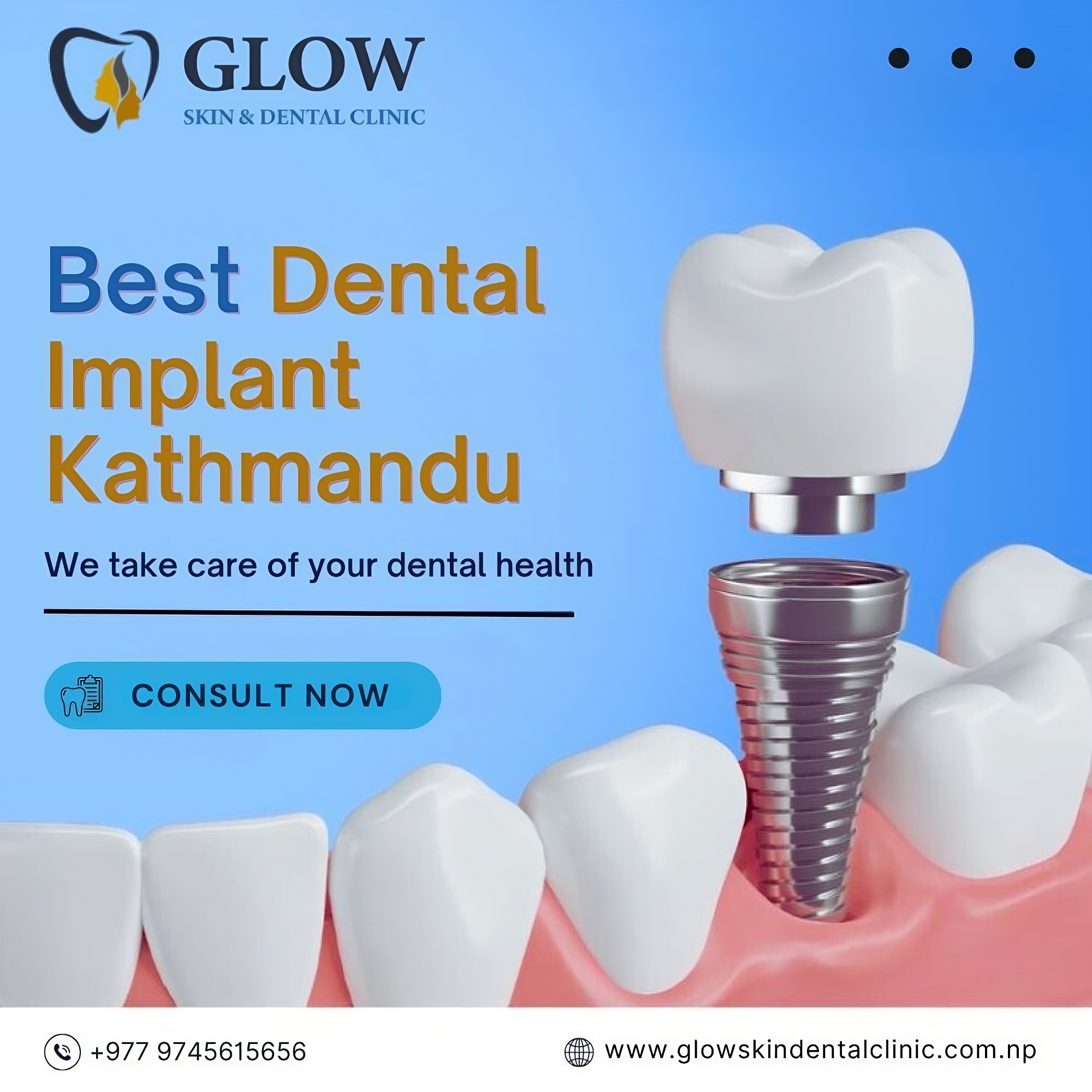 Best Dental Implant Kathmandu